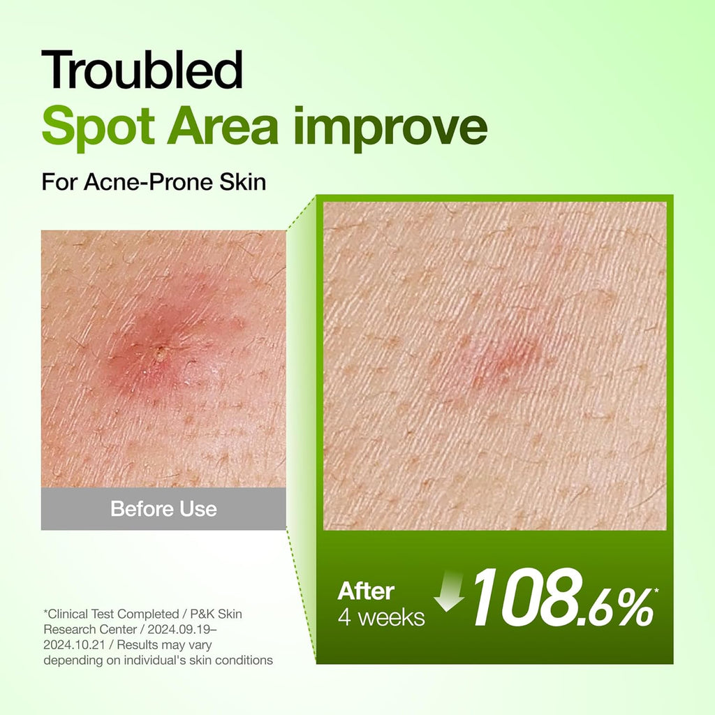 Anua Azelaic Acid 10 Hyaluron Redness Soothing Serum, Facial Serum for Blemish-Prone & Oily-Prone Skin, Lightweight & Hydrating Blemish Care, Hyaluronic Acid, Korean Skincare,